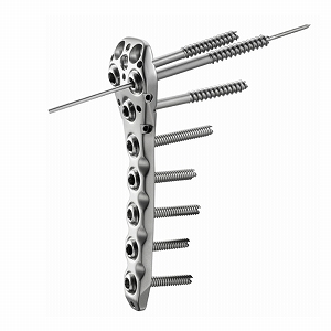 NCB® 上腕骨近位用プレート (製造販売企業:ジンマー バイオメット合同