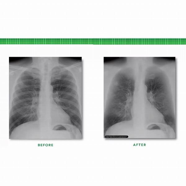 胸部X線読影支援システム ClearRead XR | 映像情報Medical